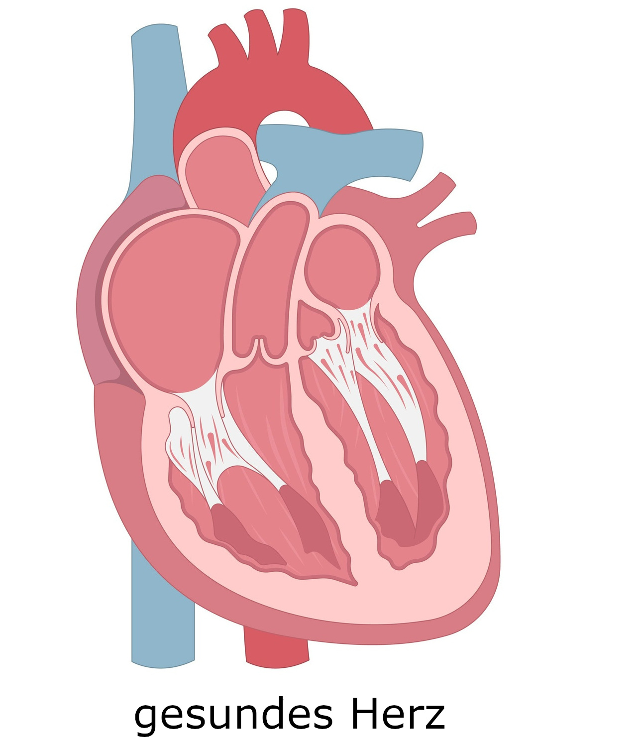 Grafik Herzmuskelerkrankung