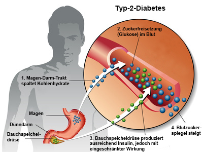 Grafik Typ-2-Diabetes Entstehung