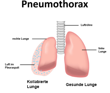 Illustration Pneumothorax